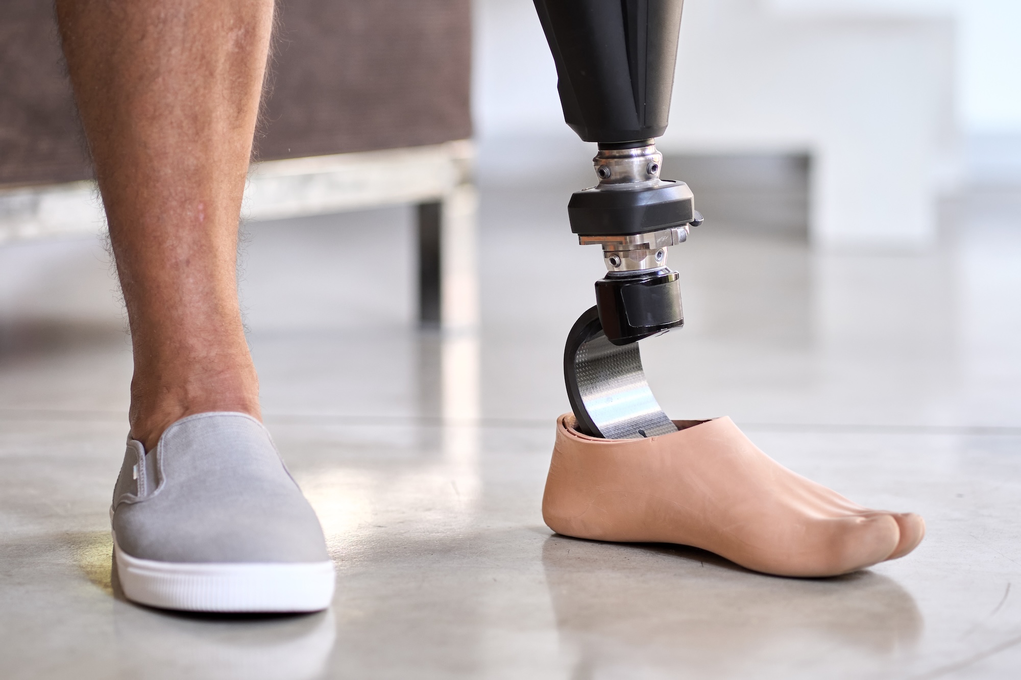 Orthopädie- und Sanitätshaus Dreschers – Nachsorge nach einer Amputation Orthopädie- und Sanitätshaus Dreschers - Nachsorge nach einer Amputation